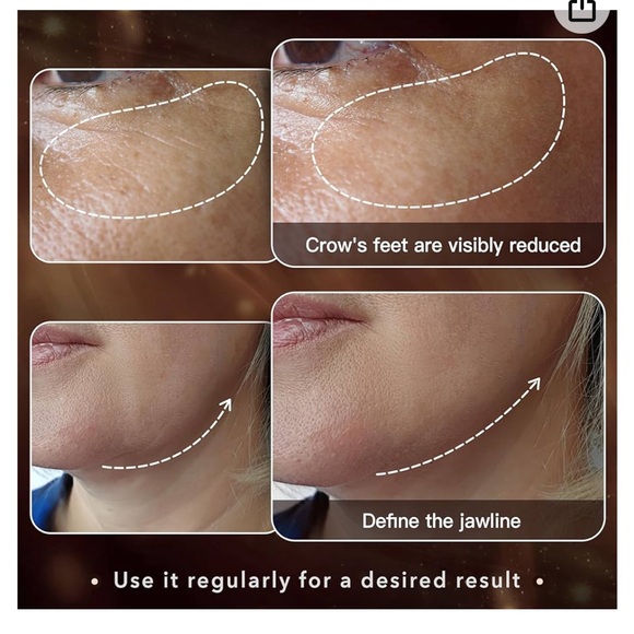 MLAY Radio Frequency Skin Tightening Machine - Picture 15 of 16